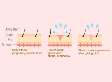 Baby’s growth causes stretchmarks